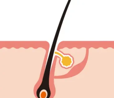 chute de poil LARA SENSE