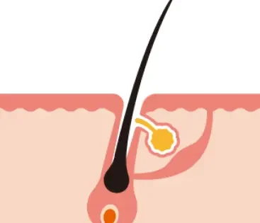 chute de poil LARA SENSE