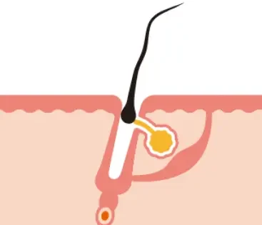 chute de poil LARA SENSE